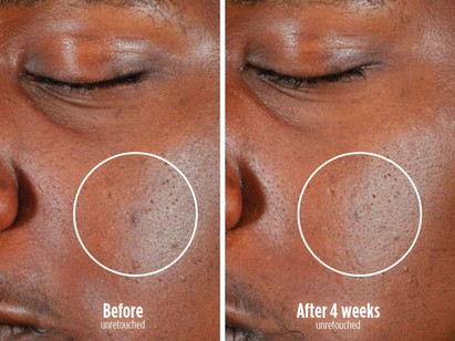 Chemical-Free Blemish Control