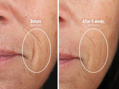 Skin-Smoothing Wrinkle Targeting